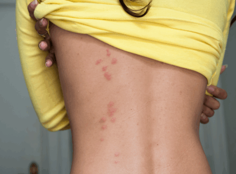 The Ultimate Guide to Bedbug Prevention and Treatment in Epping